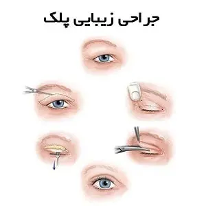 بهترین دکتر جراح افتادگی پلک در مشهد
